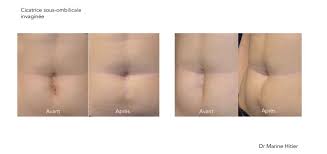 Si tu l'actives tu recevras. Correction Cicatrices Annecy Docteur Marine Hitier