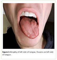 Persistent Isolated Unilateral Hypoglossal Nerve Palsy Insight Medical Publishing