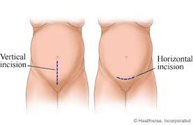 Caesarean Section What To Expect At Home