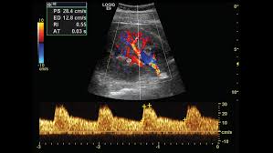 Segmental Renal Arteries On Ultrasound Google Search
