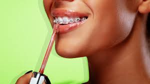 Those allergic to peroxide should askmen may get paid if you click a link in this article and buy a product or service. What It S Really Like To Have Braces Again In Your 30s Sheknows