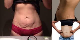 Should i just cash in and get a tummy tuck? Stretch Marks Saggy Skin Excess Fat Oh My Diary Of A Fit Mommy