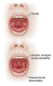 Sleeping in an inclined position will unblock your nose and help you sleep better with a sore throat. When You Have A Sore Throat