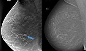 Ten percent of women return and of that percentage only 8 to 10 percent are biopsied. Ready To Take Over