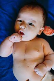 Before Ripley was even born, his parents knew he had a congenital heart  defect called tetralogy of Fallot, but they didn't expect that he'd be  rushed into open heart surgery at just