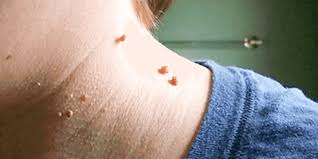 Lump in the armpit is likely to be a lymph node, which is swollen and enlarged due to an infection. Skin Tag Treatment Advanced Cosmetic Medicine Dr Targett
