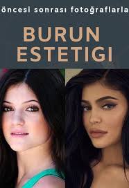 Burun Estetigi Oncesi Sonrasi Fotograflar Bursa Kadin Yuzu Rinoplasti