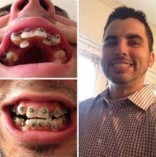 We did not find results for: 114 Incredible Before After Transformations Of People Who Wore Braces Bored Panda