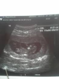 Ecografia De 11 Semanas Que Creen Ustedes Nina O Nino Club De Bebes Septiembre 2017 Babycenter