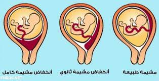 تجربتي في رفع المشيمة موسوعة إقرأ تجربتي في رفع المشيمة و اكلات تساعد على رفع المشيمة