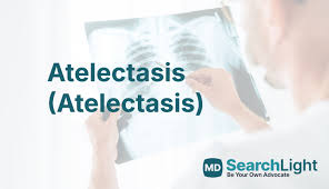 Image result for Atelectasis