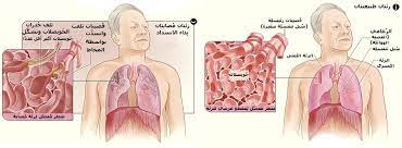 The editor in chief of copd: Ø¯Ø§Ø¡ Ø§Ù„Ø§Ù†Ø³Ø¯Ø§Ø¯ Ø§Ù„Ø±Ø¦ÙˆÙŠ Ø§Ù„Ù…Ø²Ù…Ù† ÙˆÙŠÙƒÙŠØ¨ÙŠØ¯ÙŠØ§