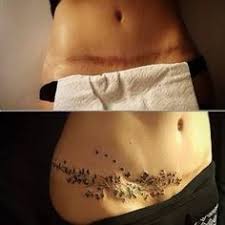 The cost of your stomach tattoo depends on the size and design of your tattoo. Scar Cover Tattoo