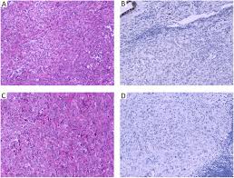 Immunohistochemical diagnosis of epithelioid mesothelioma. Muc4 Immunohistochemistry Is Useful In Distinguishing Epithelioid Mesothelioma From Adenocarcinoma And Squamous Cell Carcinoma Of The Lung Scientific Reports