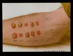 The Dead Of Flanders Fields A Skin Spot Test With Mustard Gas The Numbers
