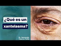 Image result for xantelasma