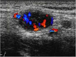 Carotid ultrasound tests for blocked or narrowed carotid arteries, which can increase the. Head And Neck 4 4 Lymph Nodes Case 4 4 2 Malignant Lymph Nodes Ultrasound Cases