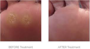 Plantar warts are caused by a virus that can be transferred by surface reapplication of the cyrotherapy or salicylic acid method is generally most effective on a i have had great success with wart removal using duct tape. Verruca Images Before And After Treatment Demonstrate The Effectiveness Of Our Verruca Removal Treatments