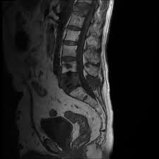 Prostate cancer is one of the most common types of cancer diagnosed in men. Vertebral Metastases From Prostate Cancer Radiology Case Radiopaedia Org