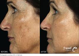 Fraxel results after 1 treatment. Fraxel Restore Laser Skin Rejuvenation Royal Tunbridge Wells Kent Uk
