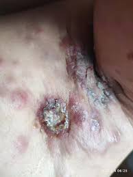 乳癌 末期 画像