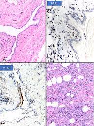Maybe you would like to learn more about one of these? Malignant Mesothelioma In Situ Morphologic Features And Clinical Outcome Modern Pathology
