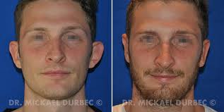 C'est un problème très fréquent, et qui n'est donc pas anormal, mais qui peut susciter un harcèlement dès l'enfance. Otoplastie A Lyon Chirurgie Esthetique Des Oreilles Decollees Dr Durbec