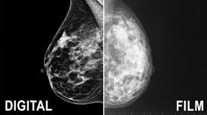 Not all breast cancers can be found on mammograms, especially in younger women who have more dense breast tissue. 3d Mammograms Beverly Hills Bedford Breast Center