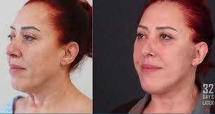 Neck lift Prices & Packages 2025