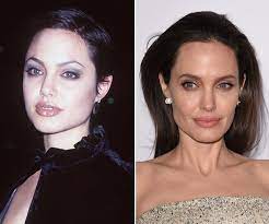 Bichectomia cirurgia angelina jolie bochechas antes depois beleza reduz famosas diminuir velhice quais consequencias dessa vogue. Bichectomia A Cirurgia Que Reduz As Bochechas Medo De Dentista