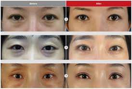 Partialincisional Transconjuctival Blepharoplasty Fullincisional Nonincisional Repositioning Eye Surgery Plastic Surgery Recovery Blepharoplasty Recovery