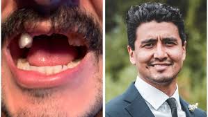 Fundraiser by Fernando Polanco : Front teeth for Fern