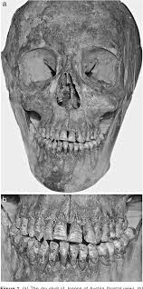 Also called the habsburg lip and the austrian lip, the habsburg jaw is a physical condition known by the modern term mandibular prognathism. Figure 1 From Retrognathic Maxilla In Habsburg Jaw Skeletofacial Analysis Of Joanna Of Austria 1547 1578 Semantic Scholar