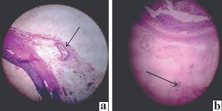 Here, we present two cases, both with clinical signs of acute abdomen. Jcdr Appendices Epiploicae Lymphoid Infiltration Mesentery Torsion
