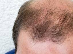 This can result in the loss of both underarm and pubic hair. Dht Dihydrotestosterone What Is Dht S Role In Baldness