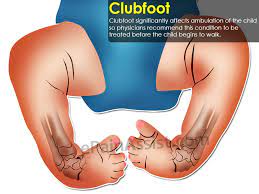 Do you have pain in the ball of your foot? Clubfoot Treatment Causes Symptoms Diagnosis