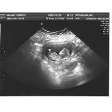 But if you are feeling some uncomfortable symptoms, things may seem like they're dragging. Pin On Ultrasound Pictures