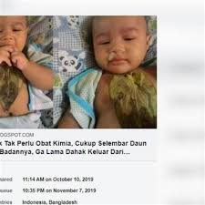 Pada bayi di atas 6 bulan, karena asupan imonoglobulin dari asi sudah semakin sedikit, malah ada yang sudah putus, tentu bayi memerlukan andalan lainnya untuk melawan penyakit pilek. Cara Buang Kahak Bayi 5 Petua Hilangkan Hingus Dan Selsema Bayi Dewi Malaysia Kahak Tersumbat Menjadi Punca Kepada Bayi Tidak Mahu Menyusu Primaxst