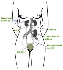 Kidney Transplantation Wikipedia