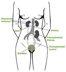 kidney transplantation wikipedia