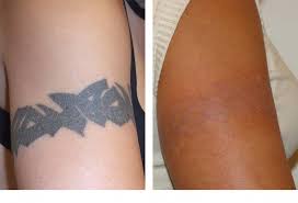 Trust the laser specialists at removery to help you find the right laser treatment for your tattoo. Laser Tattoo Removal Epione