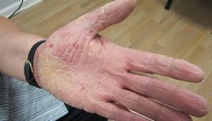 Here's a few tips to help self diagnose if it's ringworm or eczema. Scaling Rash On The Palms Clinical Advisor