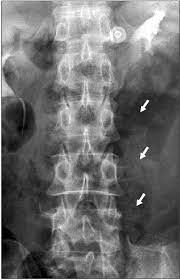 Maybe you would like to learn more about one of these? Anteroposterior Radiograph Of The Lumbar Spine Shows A Fracture Of The Download Scientific Diagram