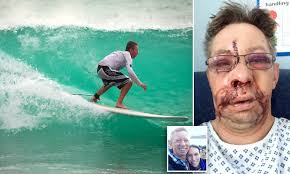 By rich francis november 8, 2020. Cornish Surfer 43 Needed A Facelift After Awful Wipeout Daily Mail Online
