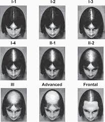 Acute hair loss may be a significant side effect of pcos. The Well Rounded Mama Pcos And Hair Loss Part 1 Prevalence And Diagnosis