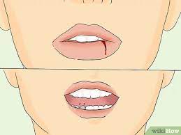 Comment Traiter Une Levre Enflee 15 Etapes Wikihow