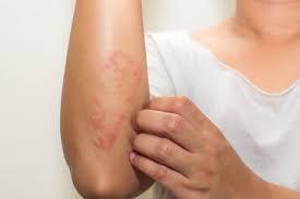 Image result for dermatitis contacta allergica