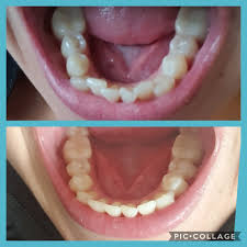 Maybe you would like to learn more about one of these? Invisilign And Yellowing Teeth Invisalign