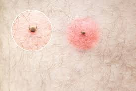 Sep 16, 2019 · le virus zika est un flavivirus transmis par les moustiques du genre aedes. Maladie De Lyme Symptomes Traitement Photo 3 Stades