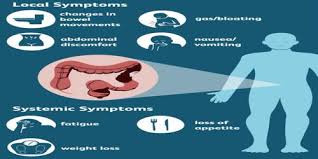 Colon cancer affects the entire colon, whereas rectal cancer impacts the lower part of the colon. Colorectal Cancer Symptoms Diagnosis Treatment Assignment Point